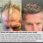Before and after scalp hair density comparison using AlphaInfuse