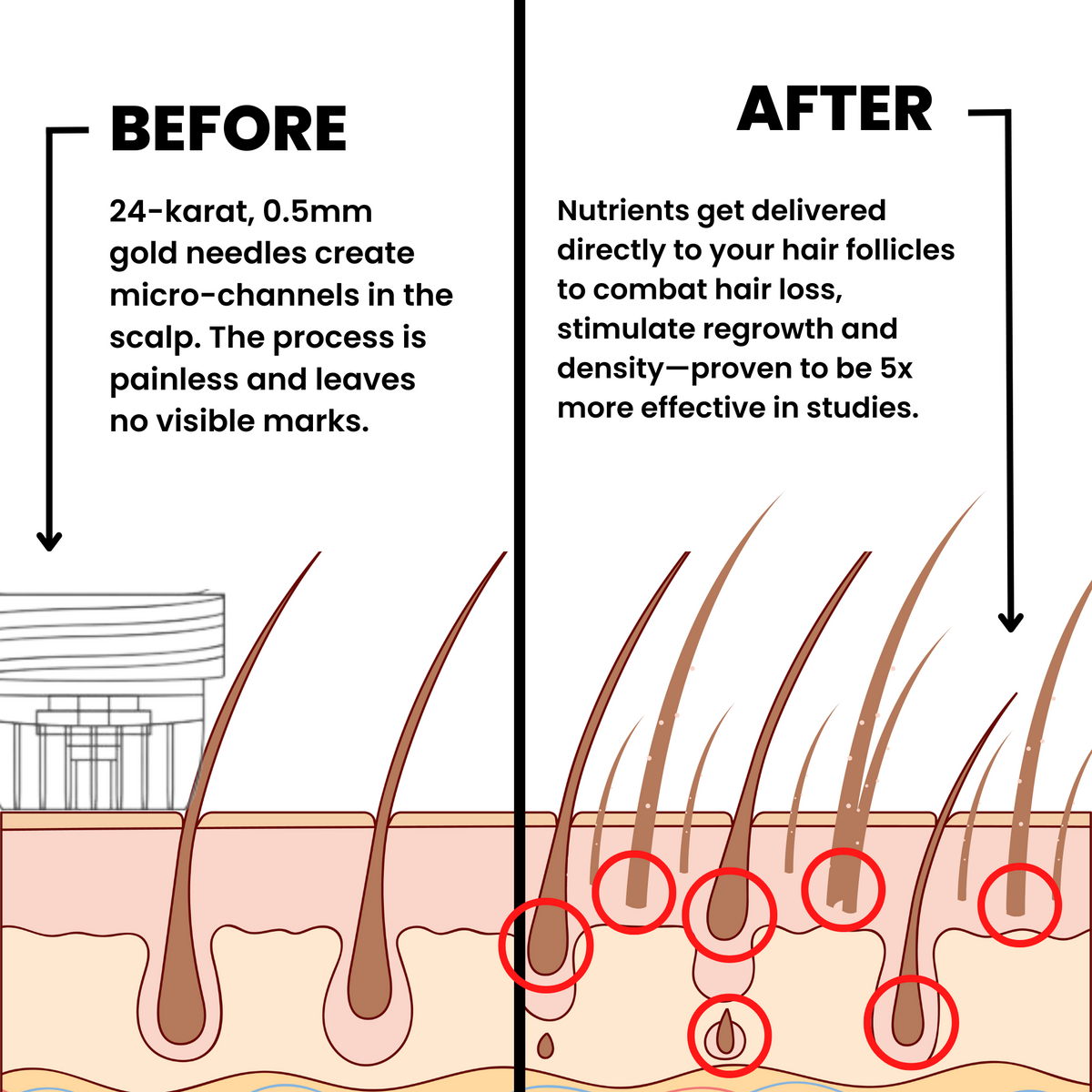 AlphaInfuse hair micro-infusion diagram showing targeted scalp application