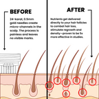 AlphaInfuse hair micro-infusion diagram showing targeted scalp application