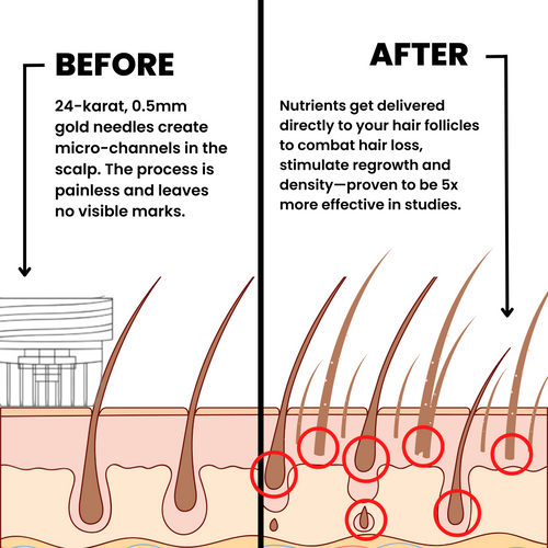 AlphaInfuse hair micro-infusion diagram showing targeted scalp application