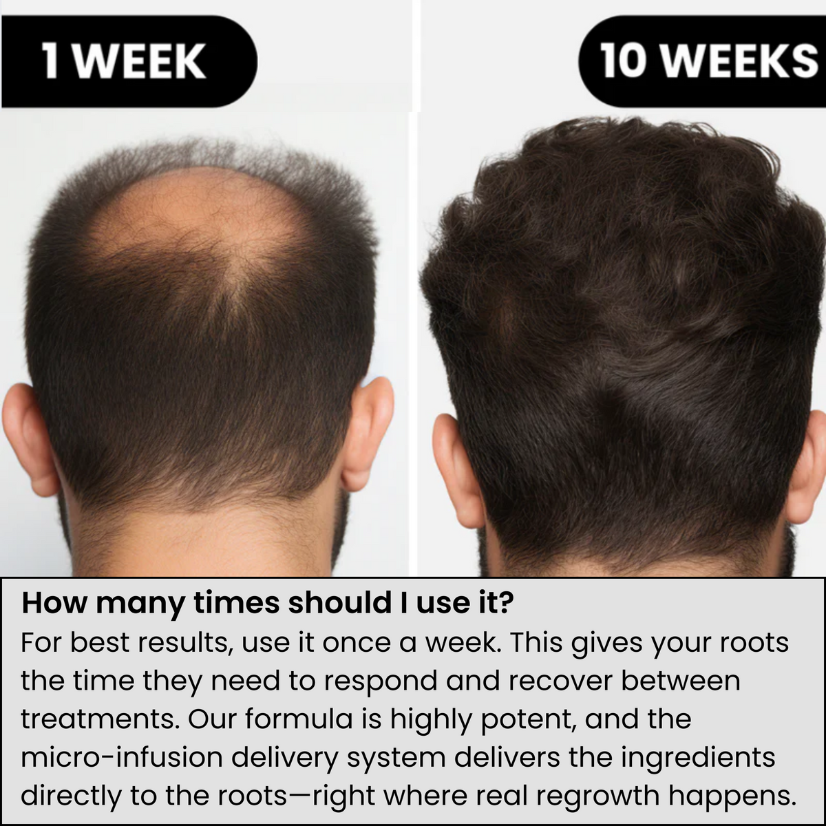 AlphaInfuse hair density comparison after consistent micro-infusion use