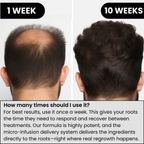 AlphaInfuse hair density comparison after consistent micro-infusion use